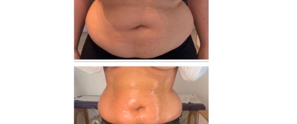 6 seances lipocavtation et radio-fréquence a nice 